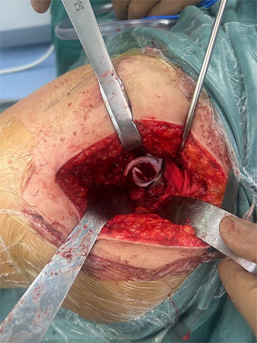 Postero-lateral approach with ceramic liner fragment.