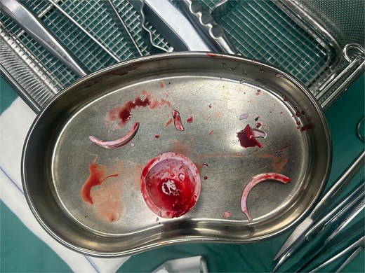 The ceramic liner fragment on the kidney basin.