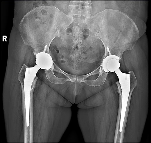 Radiograph obtained 2 months postoperatively.