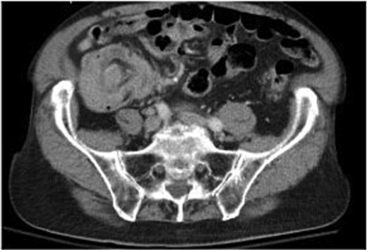 Axial view of the ileocecal intussusception.