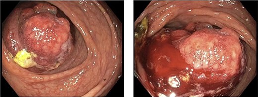 Visualization of cecal mass during colonoscopy.