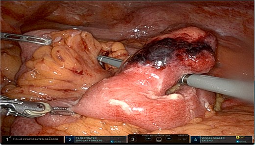 Intraoperative image of Meckel diverticulum.
