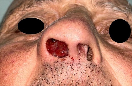 Image showing the macroscopic aspect of the tumor.