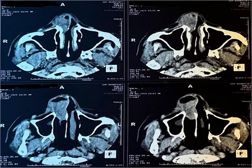 Tomography image of the paranasal sinuses in axial slice with parenchymal window revealing a tumoral-like mass in the right nasal cavity, centered on the right inferior turbinate.