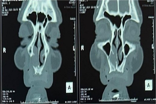 Tomography image of the paranasal sinuses in coronal slice with parenchymal window revealing a tumoral-like mass in the right nasal cavity, centered on the right inferior turbinate.