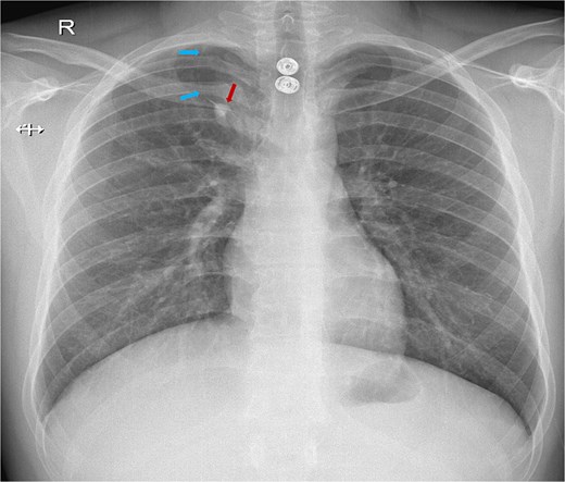 Chest X-ray showing a white line crossing from the lateral to the medial side of the right upper lung. The blue arrows indicate the azygos fissure, while the red arrow points to the azygos vein located at the base of the fissure with the characteristic ``tear drop'' sign.