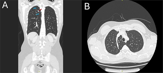 CT chest demonstrating the azygos lobe. (A) Coronal view with blue arrows indicating the azygos fissure and the red arrow pointing to the azygos vein. (B) Axial view shows the azygos fissure is seen as a curved, sharply marginated line in the right upper lobe, typically situated anteromedially.
