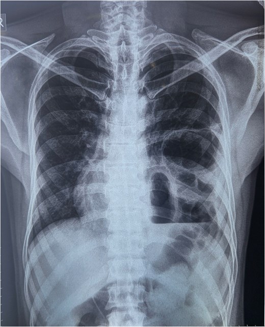 X-ray s/o air-fluid level in left hemithorax.