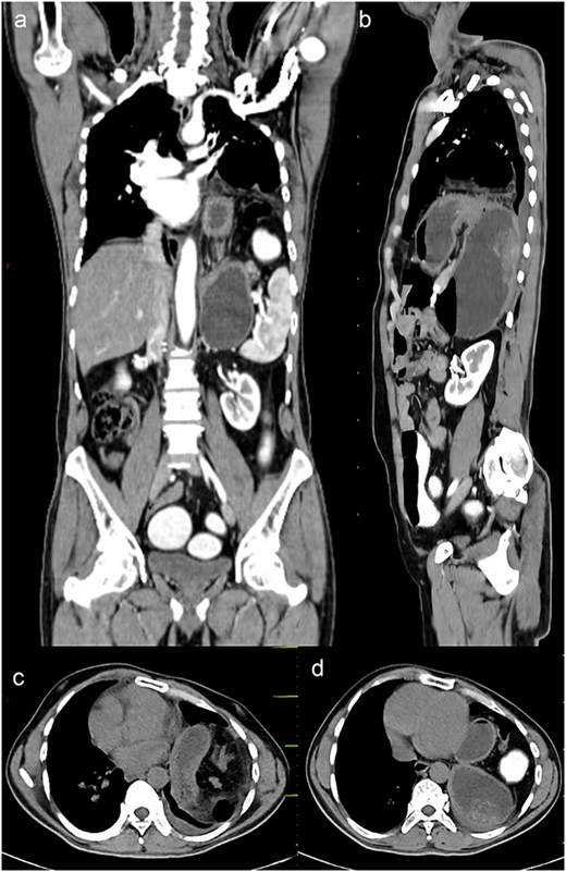 CECT abdomen and pelvis. (a) Sagittal view, (b) coronal view, (c, d) axial view.