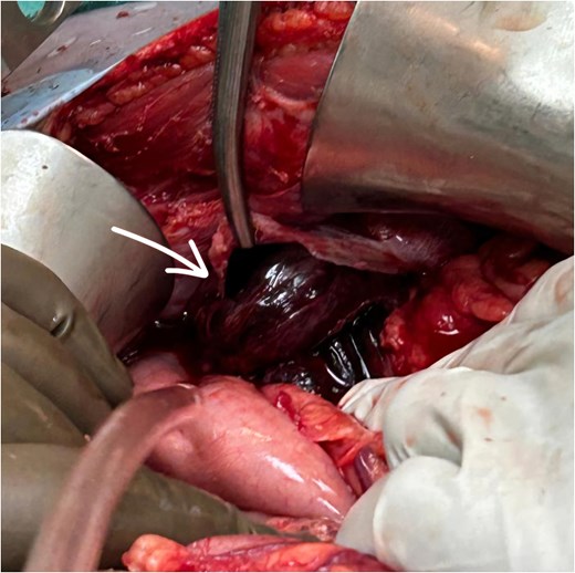 Arrow showing diaphragmatic defect with its contents.