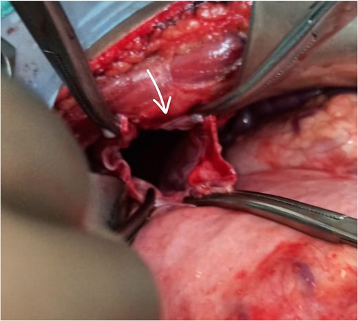 Arrow shows the defect.