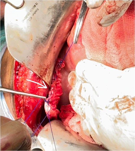 Shows the repaired diaphragmatic hernia defect.