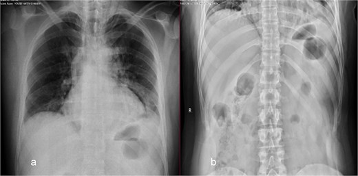 Chest (a) and standing abdomen (b) X-ray: Showed wide mediastinum with pneumomediastinum more at left side and right bronchus bulge. Normal standing abdomen X-ray.
