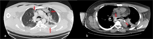 Chest CT scan: (a) with IV contrast, extensive pneumomediastinum as well as extensive cervical and anterior chest subcutaneous surgical emphysema with mild bilateral pleural effusion. (b) IV and oral contrast: Evidence contrast leakage arising from the left posterolateral aspect of mid esophagus associated with mild left loculated pleural effusion and mild pneumomediastinum.