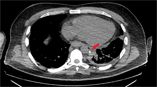 Chest CT scan with oral contrast showing significant reduction in the amount of leaked contrast (small rim remaining) with mild decrease in the amount of left pleural effusion and associated collapse consolidation as well as pneumomediastinum.