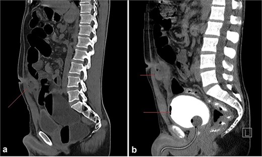 (a) A round to oval shaped, thick walled, fluid filled cystic lesion (34 HU) measuring ~3.6 × 3 × 4.6 cm is noted at the level of the umbilicus, subjacent to the rectus abdominus muscles; it appears to be in communication with the umbilicus. Few tiny air locules are noted within. (b) Retrograde cystourethrogram showing an intact urinary bladder with mild diffuse thickening of the wall. No communication can be seen between the abscess cavity and the bladder.