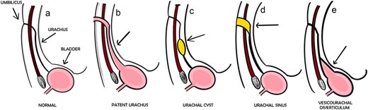 Types of urachal malformations.