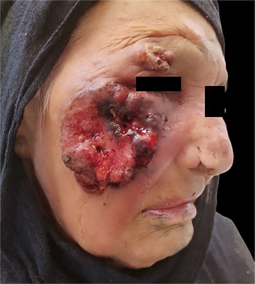 Ulcerating and fungating lesion in the right cheek.