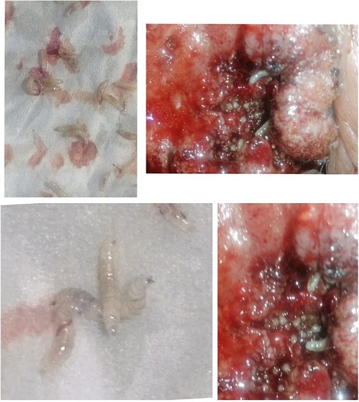 Maggots within the lesion and outside the lesion.