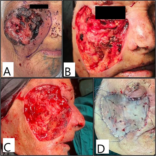 Intraoperative photos showing (A) marking of excision margins; (B, C) the resultant defect after excision and (D) after split-thickness skin graft application and fixation.