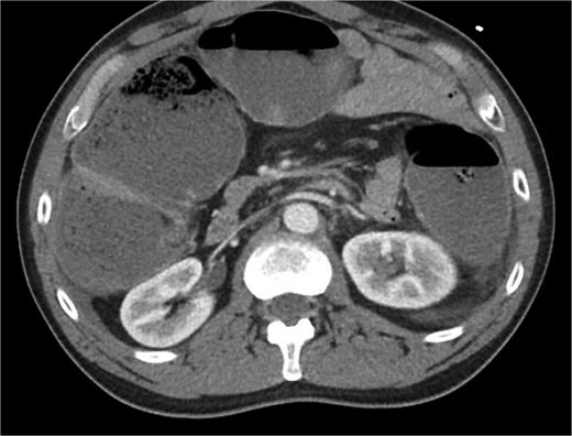 Axial imaging demonstrating significant colonic dilation. There was no evidence of pneumatosis or pneumoperitoneum.