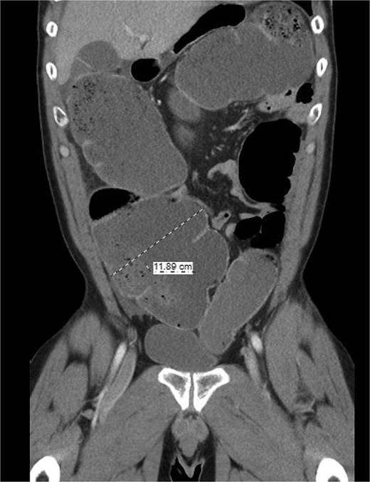 Coronal imaging demonstrating significant colonic dilation up to 11.9 cm in the cecum.