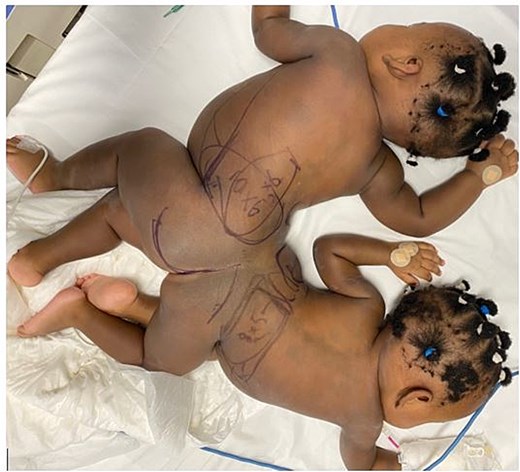 The conjoined twin girls, before the separation.