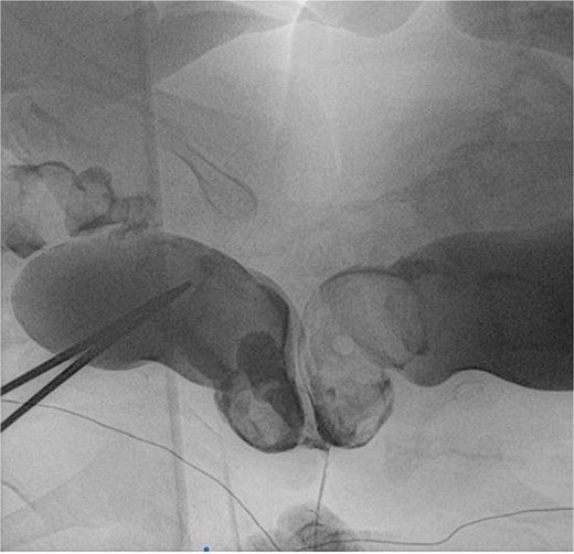 Rectal contrast filled two separate rectums fused distally to form a single anal canal.