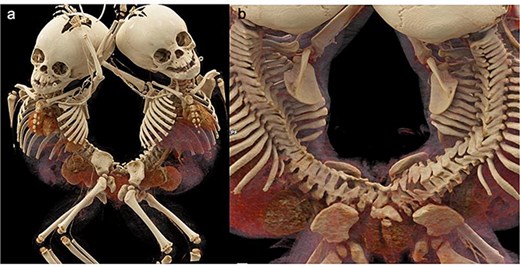 3D CT demonstrations of pygopagus twins. (a) Anterior and posterior views. Scoliosis and multiple segmentation and fusion anomalies of several vertebrae and sacrums of both babies, more so in the baby on the right, (b) distal sacral and coccygeal fusion.