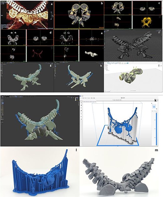 Steps for 3D model preparation: (a) examination of the radiological images, (b) choosing the bony structures at the MRI image, (c) obtaining the 3D model of the bony structure from the MRI image, (d) obtaining the 3D model of the vascular structures from the MRI, (e) obtaining the 3D model of the bowel from the MRI image, (f) construction of the 3D model of the bony structure, (g) arrangement and positioning of the 3D model of the spinal cord, (h) arrangement and positioning of the 3D model of the vascular network, (i) remodeling of the intestine based on the reference model obtained from radiological images, (j) arrangement and positioning of the 3D model of the bowel, (k) slice of the intestinal and vascular network model in Zortrax Z-suite software, (l) 3D printing of the intestinal and vascular network model.