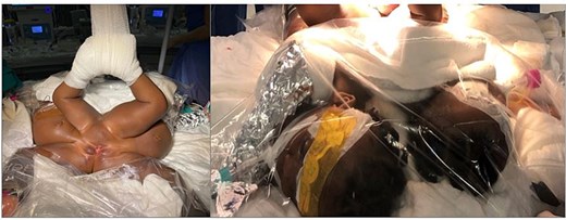 (Left) horizontal placement and the special litotomy position of the infants; (right) the twins were monitored, intubated and heat loss was prevented during the long diagnostic procedures.