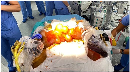 The twins were placed in prone, U-shaped position.