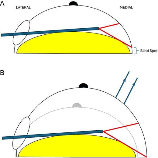 Schematic demonstrating optimization of endoscopic view of medial breast with TRACE technique.