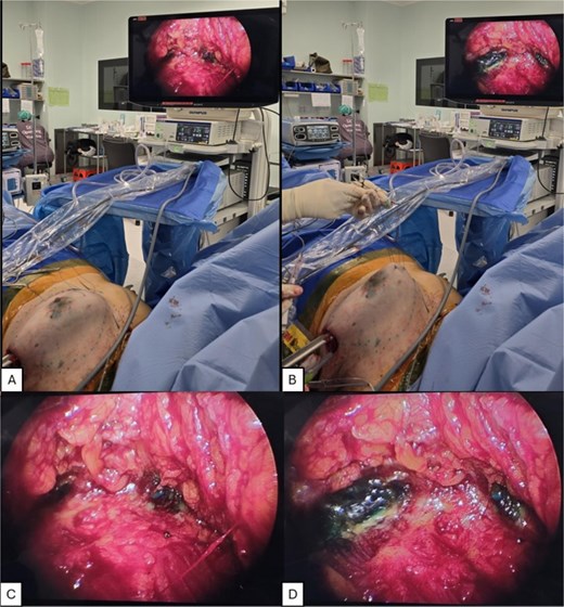 Demonstration of TRACE intraoperative views. (A,C) Without TRACE. (B, D) With TRACE.