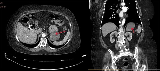 Contrast-enhanced CT, transverse, and coronal sections. Arrows: gastric duplication cyst. A slight displacement of the stomach is observed, without spleen involvement and independent from the pancreas.