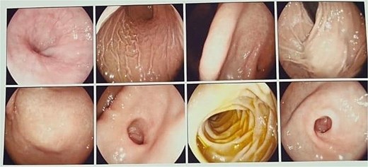 Panendoscopy. Normal gastric mucosa is observed, with extrinsic compression at the level of the fundus and antrum.