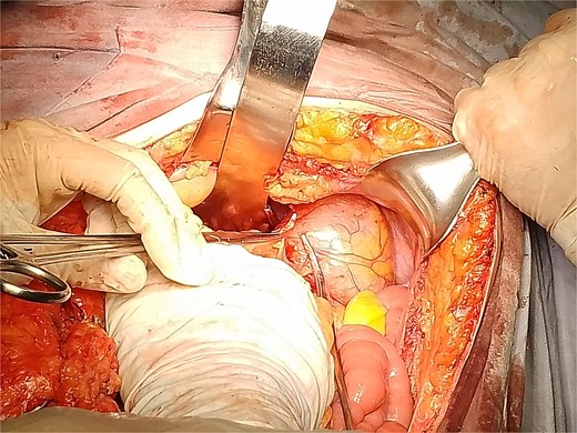 Photograph taken during surgery showing the resected gastric cyst with the surrounding anatomical structures.