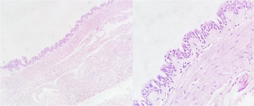 Microscopy of the gastric duplication cyst, hematoxylin–eosin stain. The presence of mucosa and submucosa is observed. Magnified view showing respiratory-type mucosal pattern (pseudostratified columnar epithelium).