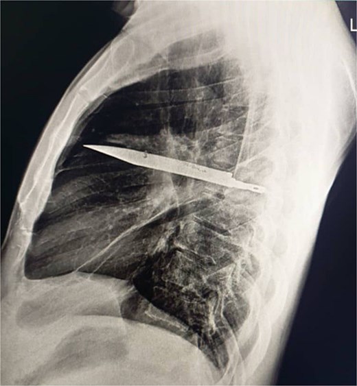 Lateral chest radiograph demonstrating a retained metallic object (knife) in the mid-thorax with surrounding opacification consistent with post-traumatic fibrosis following a stab wound.