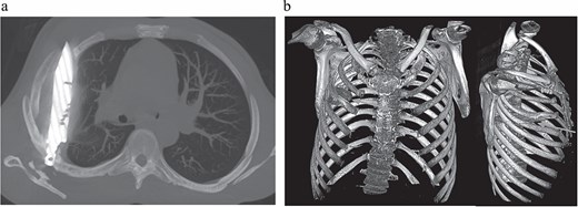 (a) CT chest maximum intensity projection (MIP) demonstrating a retained metallic foreign body (knife) traversing the right chest, with associated healed fractures. (b) 3D reconstructed CT chest image demonstrating the retained knife and associated skeletal injuries.