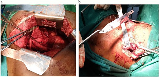 (a) An image showing a defect in middle lobe of the right lung after the removal of the large metallic foreign body. (b) An image showing a large metallic (knife) foreign body removed from the middle lobe of the right lung.