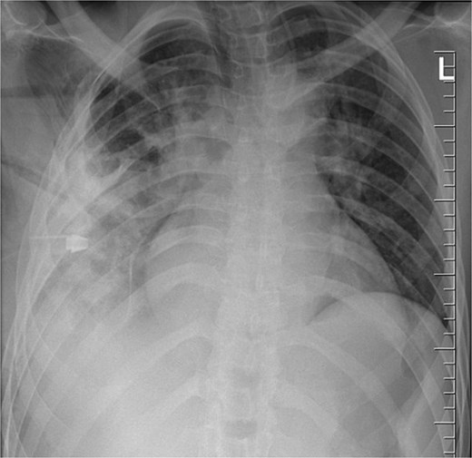 Chest radiograph post-operatively, demonstrating a chest tube in situ, residual lung opacification, and expected post-surgical changes following removal of a retained thoracic foreign body (knife).