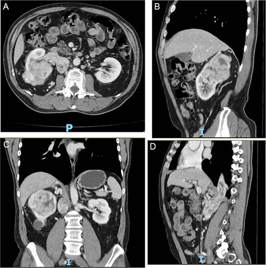(A–D) Abdominopelvic contrast-enhanced computed tomography prior to neoadjuvant therapy showing a lesion in the right kidney with associated mural thrombus extends through the azygos vein in the sagittal section.