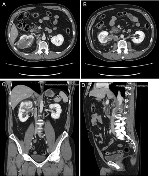(A–D) Abdominopelvic contrast-enhanced computed tomography post-neoadjuvant therapy showed a significant reduction in tumor size and the involvement of the thrombus in the azygos vein.