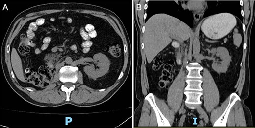 (A, B) Postoperative abdominopelvic tomography (6 months later) showing post-surgical changes consistent with right radical nephrectomy and resolution of the hematoma.