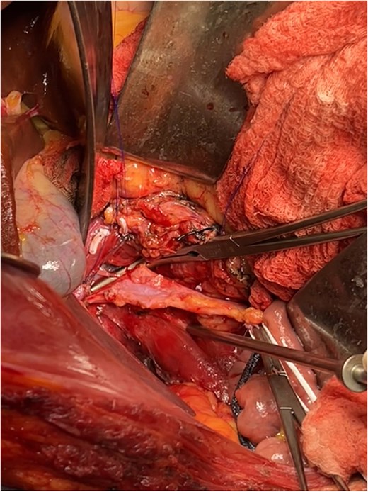 Intraoperative image following the resection of the renal tumor with thrombectomy of the azygos vein and exposure of the vena cava.