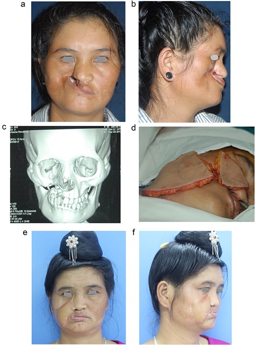 A 35-year-old female patient with NOMA diagnosed in the right maxilla, causing deformity and retraction of the upper lip and right cheek. (a and b) Preoperative images, front and lateral view, respectively. (c) X-ray of the maxillary lesion. (d) The harvested ALT flap, measuring 12 × 8 cm, with two perforators. The flap was divided into two skin islands based on two separate perforators to cover the outer skin and the inner oral cavity. (e and f) Results 3 years after surgery, upright and lateral, respectively.