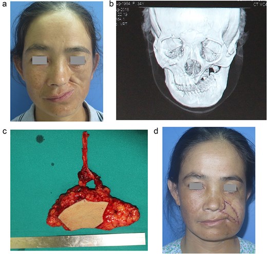 35-year-old female patient diagnosed with NOMA in the left maxilla. Deformed lesion, contracture of the left corner of the mouth, scar contracture of the left upper lip, left cheek hollow. (a) Preoperative image of the lesion; (b) X-ray film of the maxillary bone lesion; (c) ALT flap measuring 11 × 5 cm, used to cover the soft tissue combined with partial de-epithelized aera to create cheek augmentation; (d) Results after 3 months.