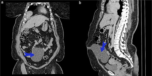 (a) CT scan of abdomen coronary view. (b) CT scan of abdomen sagittal view.