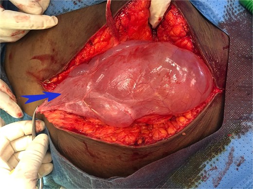 Intraoperative image showing urachal cyst.